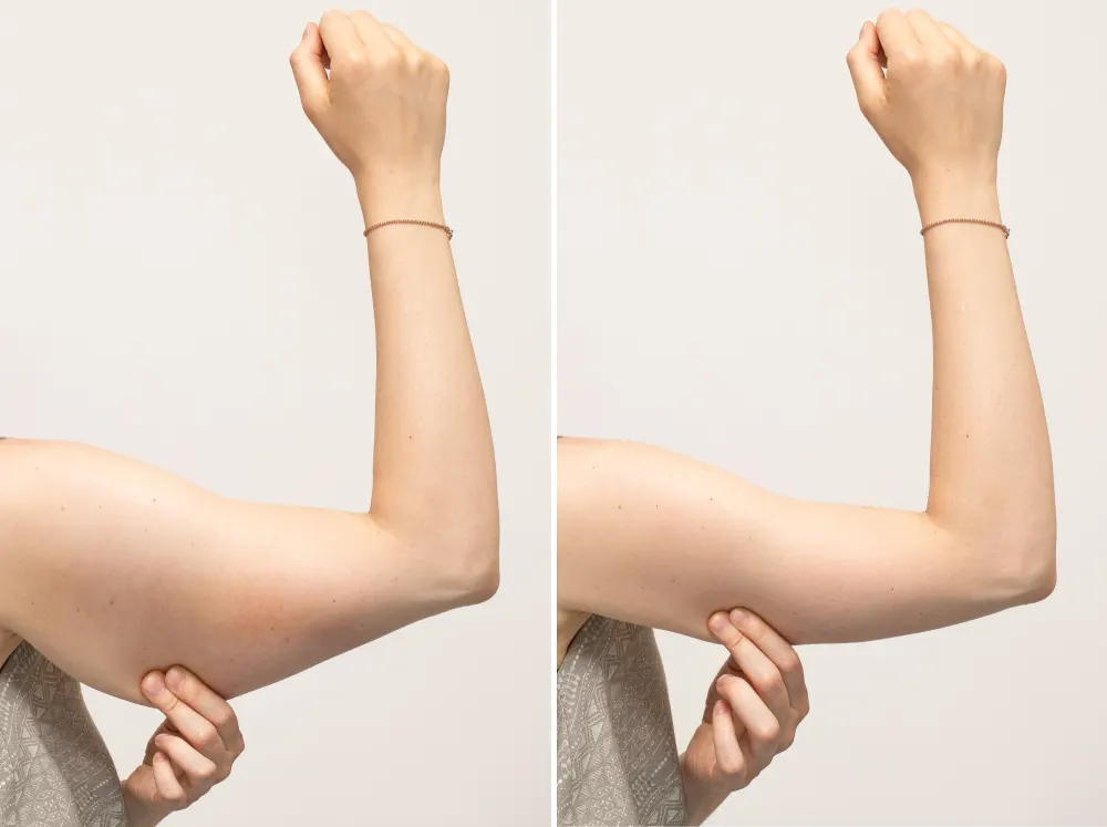سوالات جراحی لیفت بازو توسط بهترین متخصص زیبایی